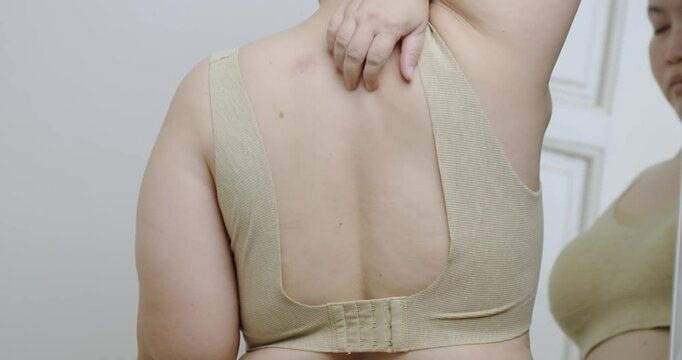 Asian woman scratches a red rash on his back in close-up. Allergies and skin diseases.