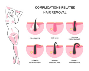 Ingrown hair, problems after hair removal, complications after epilation or depilation. Complications related hair removal.