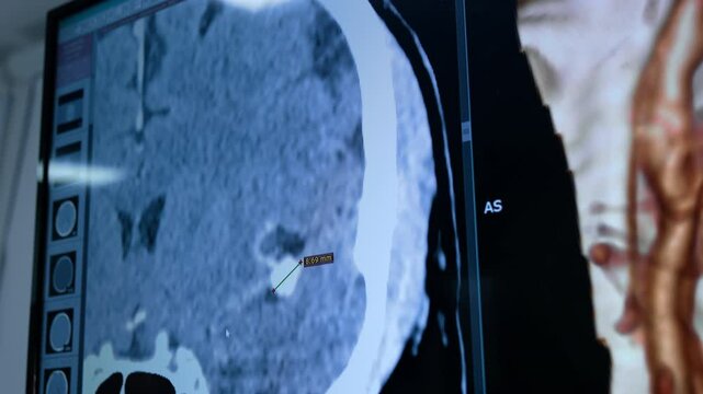 MRI brain scan of a patient with a white spot measured by the computer. Area of brain aneurysm identified by the doctors before operation. Close up.