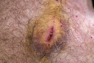 Colourful bruising emanating from injuries to stomach and chest caused by falling onto a metal...