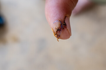 Nasty cut on a thumb finger with stitches