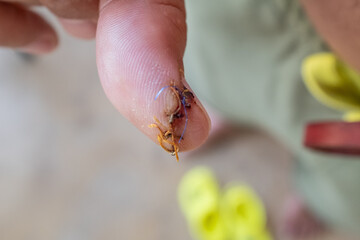 Injured thumb finger with a cut and four stitches