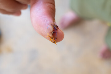 Nasty cut on a thumb finger with stitches