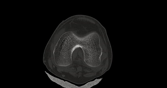 Knee Joint CT-Scan Revealing Tibial Fracture:The scan highlights a distinct fracture in the tibia, located beneath the knee joint. The break is visible as a crack.