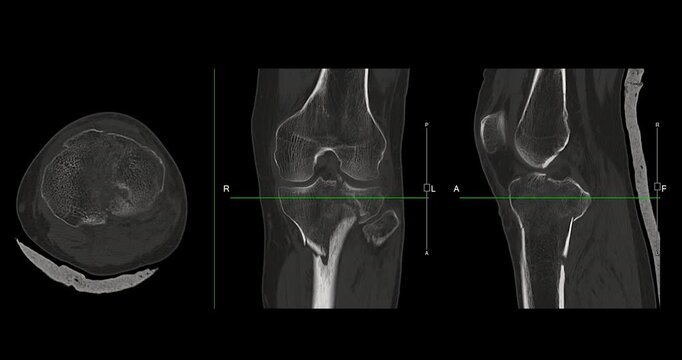 Knee Joint CT-Scan Revealing Tibial Fracture:The scan highlights a distinct fracture in the tibia, located beneath the knee joint. The break is visible as a crack.