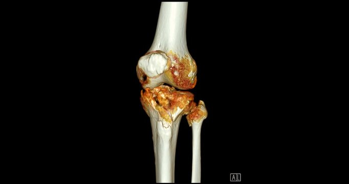 Knee Joint CT-Scan Revealing Tibial Fracture:The scan highlights a distinct fracture in the tibia, located beneath the knee joint. The break is visible as a crack.