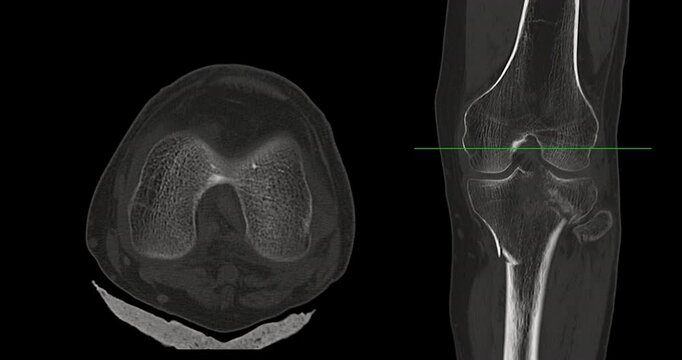 Knee Joint CT-Scan Revealing Tibial Fracture:The scan highlights a distinct fracture in the tibia, located beneath the knee joint. The break is visible as a crack.
