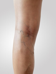 Woman with sign of varicose veins symptoms on a legs close up. Leg pain. Phlebology. Venous pathologies of the lower extremities. White background.
