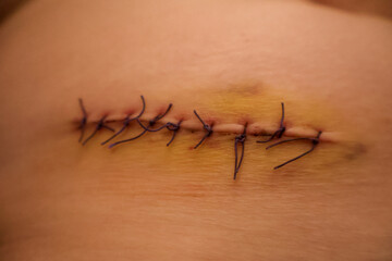 Post-Surgical Skin Stitches Close-Up on Healing Wound with Bruising
