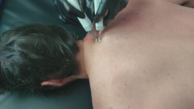 Shoulder muscle twitching when stimulated with an acupuncture pen point stimulator during an electro dry needling physiotherapy session 