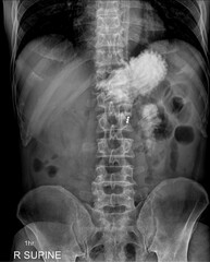 An abdominal radiograph showing a barium examination of the bowel one hour after the contrast...
