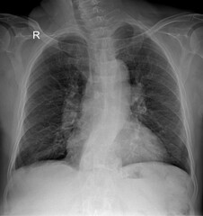 X-ray Demonstrating Trachea, Bronchi, and Lung Parenchyma for Evaluating Obstructive Pulmonary Diseases