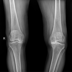 Diagnostic Radiograph of Bilateral Knee Joints for Evaluating Cartilage Loss