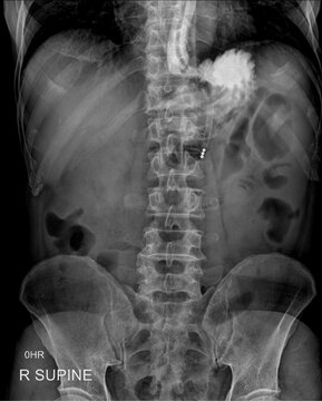 Abdomen radiograph showing barium examination 