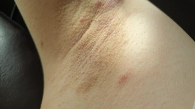 ringworm eczema infected on human body red rash ring on skin close up 4k