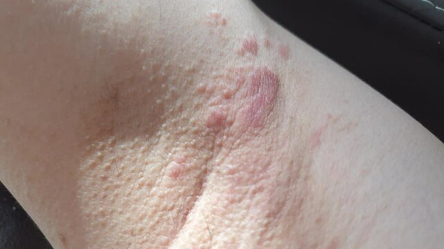 ringworm eczema infected on human body red rash ring on skin close up shot 4k