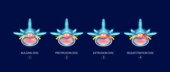 Difference between stages of herniated disc. Bulge, Protrusion, Extrusion and Sequestration. Spinal bone problems that make back and neck pain. Medical concept. Vector illustration.