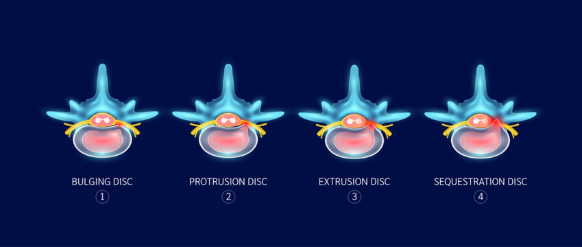 Difference between stages of herniated disc. Bulge, Protrusion, Extrusion and Sequestration. Spinal bone problems that make back and neck pain. Medical concept. Vector illustration.