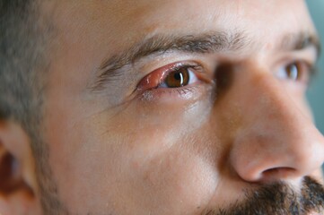 Fototapeta premium Close up left upper eye lid abscess