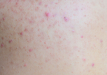 Fototapeta premium Close up of a patient's skin. Red bumps, itchy rash.