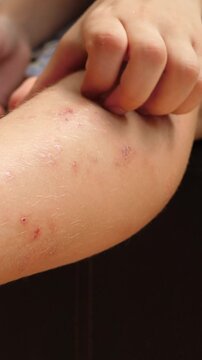 Child scratching his leg. Wounds on the skin. Insect bites in hot countries