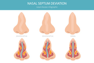 Nose Deviated Septum. Nasal diseases. Medical infographic design. Vector illustration