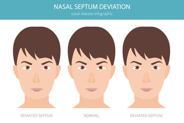 Nose Deviated Septum. Nasal diseases. Medical infographic design. Vector illustration
