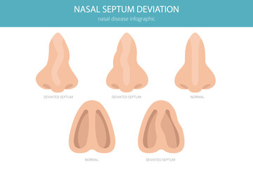 Nose Deviated Septum. Nasal diseases. Medical infographic design. Vector illustration