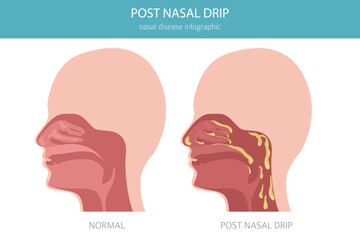 Post nasal drip. Nasal diseases. Medical infographic design. Vector illustration