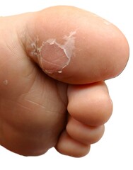 Hallux skin injury due to blister on a child's foot Close-up. On white background