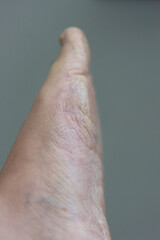 Close up of dry cracked skin on foot