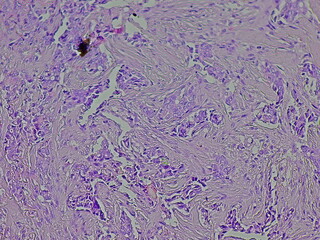 Human cervical cell tissue under microscope in pathology laboratory. Microscopic view of invasive carcinoma, adenocarcinoma of human breast cancer, hematoxylin eosin staining