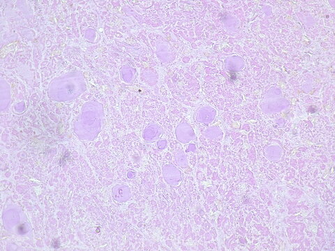 Photomicrograph showing histology of a benign thyroid nodule in a patient with multinodular goiter under microscope in pathology laboratory