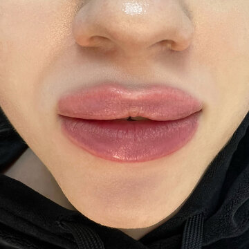 lips after the enlargement procedure