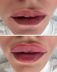 collage before and after lips after the enlargement procedure