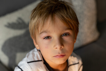 Preschool child, sweet boy with alergic reaction and swollen eye from insect bite