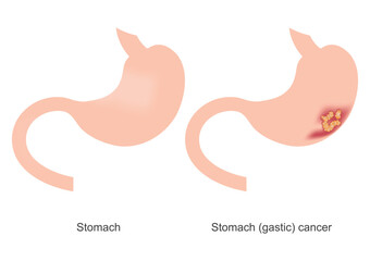 Stomach cancer which is also called gastric cancer.