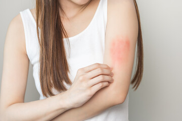 Dermatology asian young woman, girl allergy, allergic reaction from atopic, insect bites on her arm, hand in scratching itchy, itch red spot or rash of skin. Healthcare, treatment of beauty.