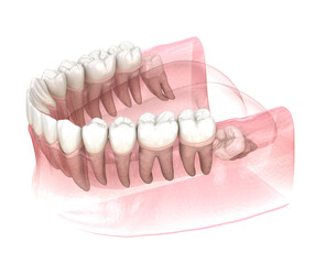 Impaction of Wisdom tooth. Medically accurate tooth 3D illustration