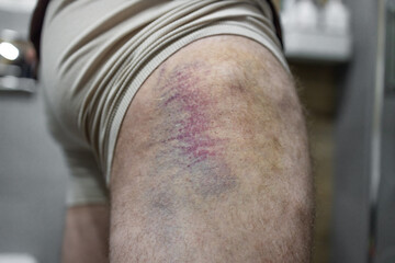 Huge yellow-blue bruise with an abrasion on the thigh