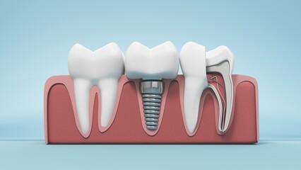 3D illustration features a molar tooth in a realistic style, highlighting its enamel and root structure. Implant image for dental, healthcare, and educational content focused on oral hygiene and treat