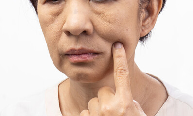 Flabby and wrinkled skin on senior woman face.