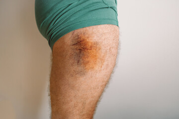 Huge yellow-blue bruise with an abrasion on the thigh