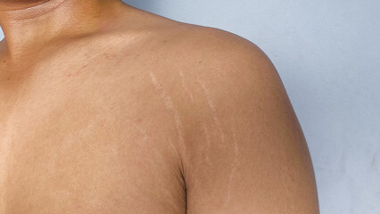stretch marks on armpit skin area	
