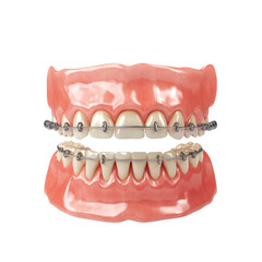Obraz premium teeth braces on a transparent background