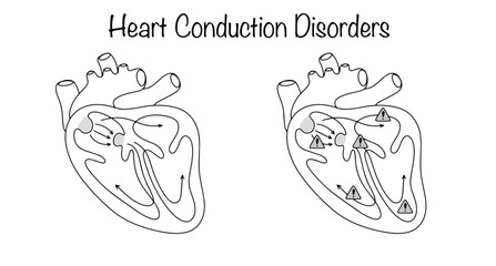 Heart Conduction Disorders