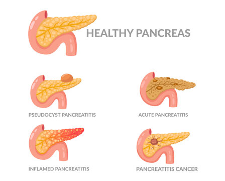 Pancreas diseases concept. Set of anatomical Illustration for medical designs. inflamed , acute , cancer and pseudocyst 