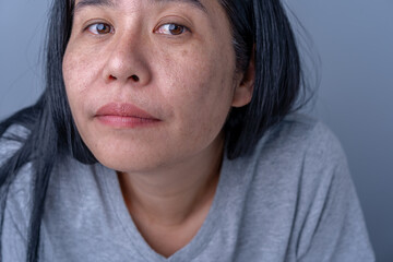 Asian adult woman face has freckles, large pores, blackhead pimple and scars problem from not take...