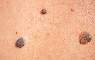 Nevus close-up. Mole on human skin. Irregular birthmark.