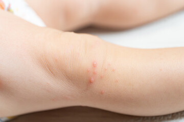 手足口病に罹患した一歳の男の子